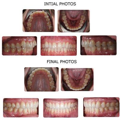 Teeth aligned and bite fixed in 9 months with Invisalign and Propel