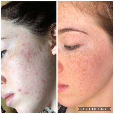 Before & after 3 treatments of microneedling