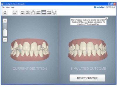 FREE Invisalign Scans