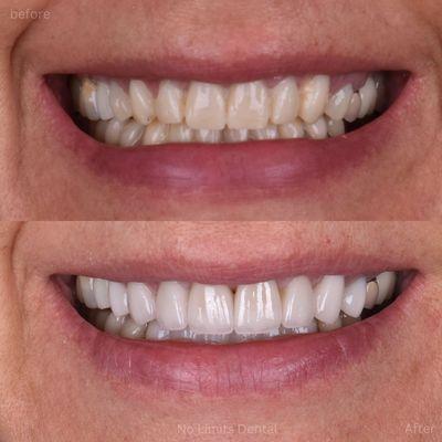 16 veneers and crowns were completed to improve the aesthetics and bite