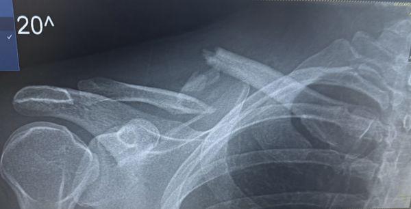 Broken clavicle