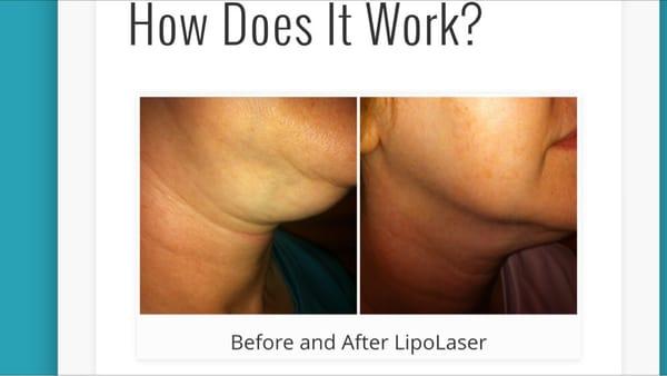 Rochester Lipo Sculpt