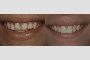 This patient had veneers placed to improve the color and shape of her teeth, resulting in a refreshed smile.