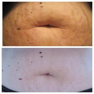 Stretch Marks? This lady used our stretch mark cream for two weeks.. these were her results!