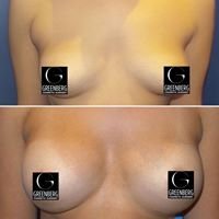 Breast Augmentation Before and After