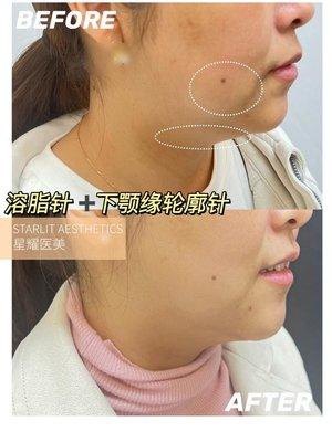 Result after fat dissolution injection