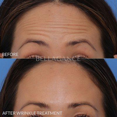 Botox for treatment of forehead wrinkles. The before and after photographs are with the patient raising her brows.