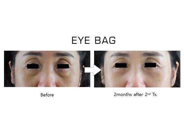 Non-surgical Eye Bag Remove