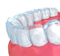 Invisalign