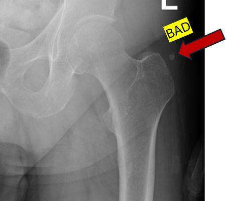 White blob consistent with symptoms. May be a "red herring" - something present on film that does not cause symptoms - but MUST be noted!