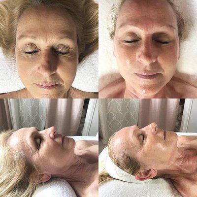 Before & After one of our amazing facials.