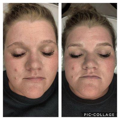 Microblading