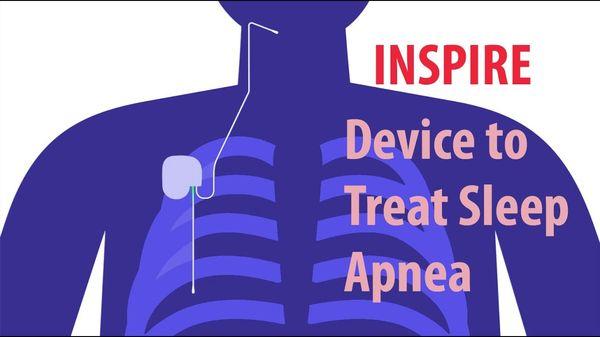 Inspire Device