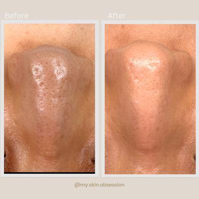 Hydrafacial before and after