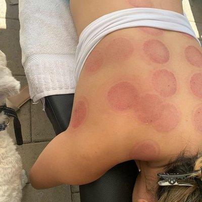 Cupping Therapy