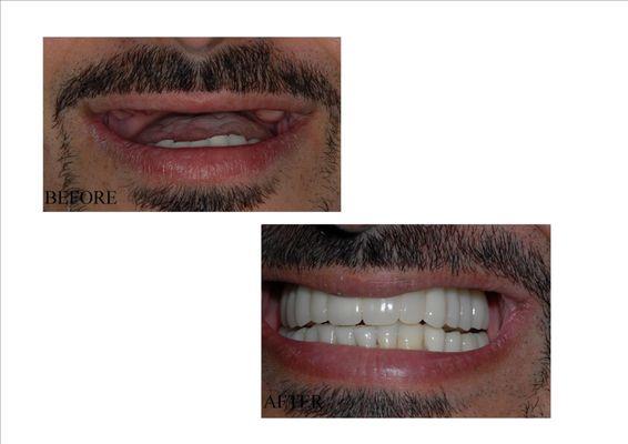 Actual patient of Dr. Khazian. Replacing all upper teeth with dental implant