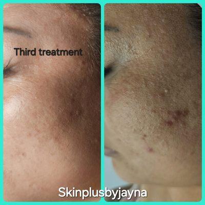 Acne treatment.  Simultaneous treatment of acne scars, acne pigments, whiteheads and millet acne trapped in the skin.