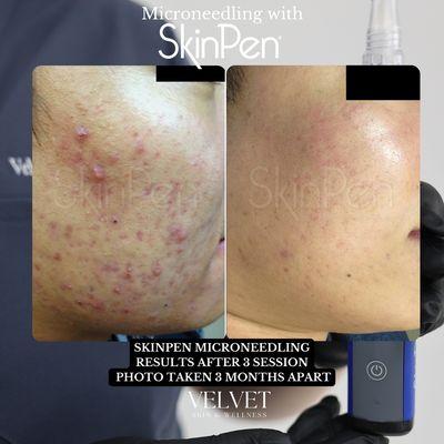 Microneedling after 3 Sessions