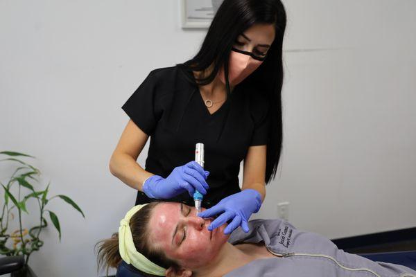 Microneedling is one of our favorite treatments to do at Jazi !