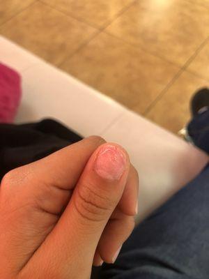 Cracked nail