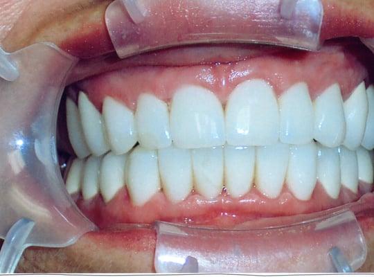 67 Year Old Female after Lava Crowns.