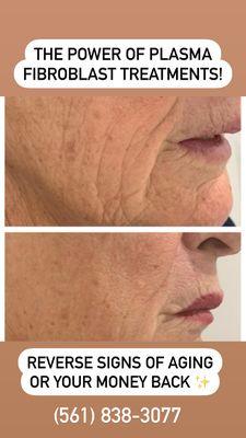 Before and after of the plasma fibroblast Skin Tightening treatment.