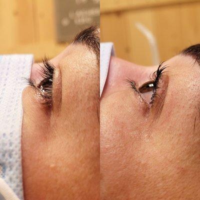 Lash lift