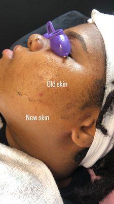 Dermaplaning facials are a game-changer for deeper product penetration and effective results.