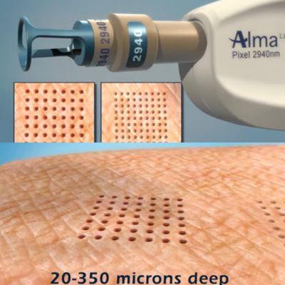 Pixel laser resurfacing goes 50-350 microns deep.