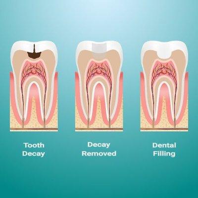 Composite dental fillings are tooth-colored resin material that restore decayed teeth. They can also be used for cosmetic rea...