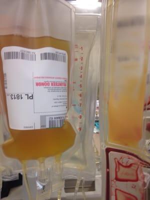 Plasma on the left, platelets on the right, given to help someone who needs them more than me! :-)