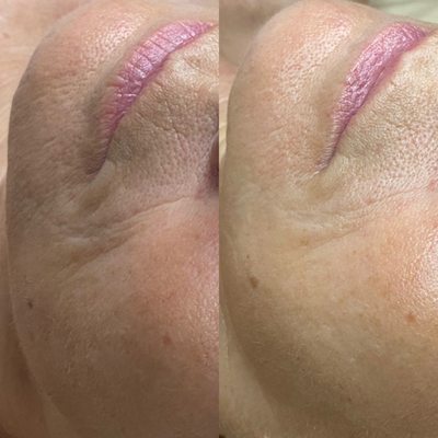 Hydradermabrasion