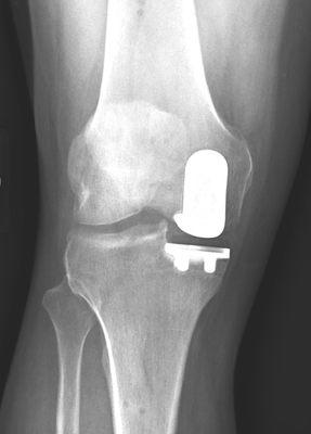 Reproducible alignment in a robotically assisted partial knee replacement