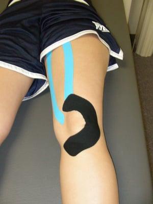 Kinesio Taping for knee pain caused by patellofemoral tracking syndrome.