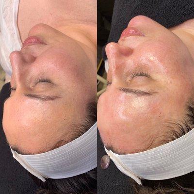 Before & After Hydrafacial with Dermaplaning