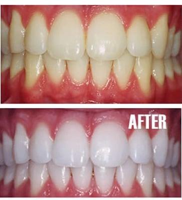 Teeth whitening before and after results