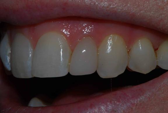 Before Replacing Anterior PFM crown with Emax Crown