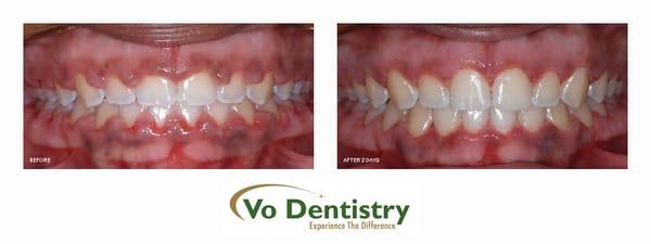 Gum surgery with minimal discomfort