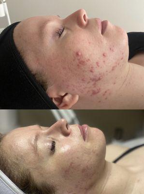 6 week difference after a dedicated skincare regimen and acne treatments. We are focusing on scar revision now.