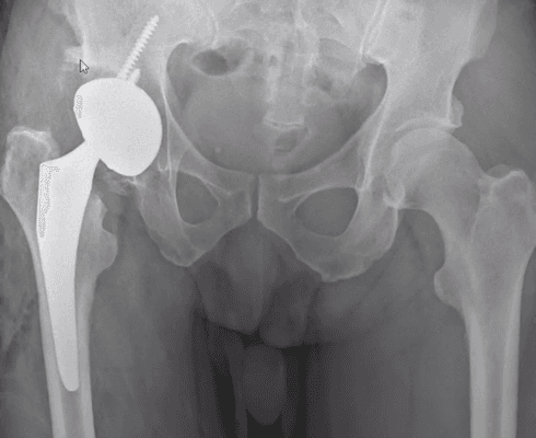 HIP CUP IN PROPER POSITION AFTER SURGERY