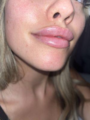 lip filler