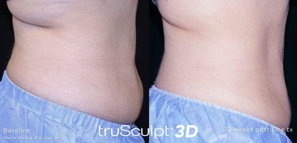 truSculpt 3D results after 12 weeks. Get your truSculpt 3D in Orange County today. Call us for our daily special discounts. Starts at $600.