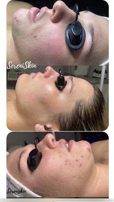 Acne treatment/derma-planing/hydra facial