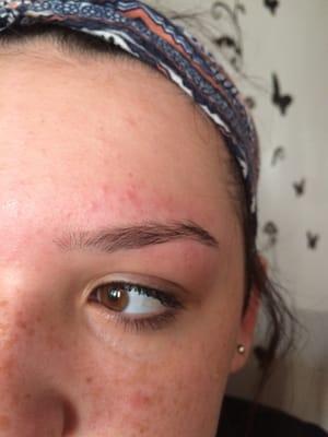 The end result . Messed up quarter of her brow Gone!!