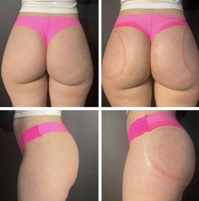 Butt cupping immediate Results