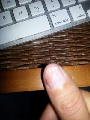 thumb nail 3/4 of it gone