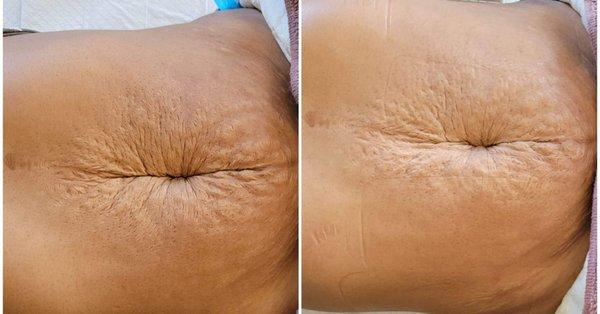 Help get your tummy back after birth. Reduce  stretchmarks with our RF Skin Tightening service