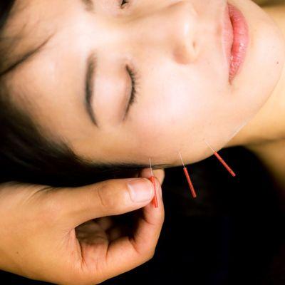 Cosmetic Acupuncture