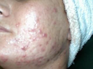 Before Photo Acne