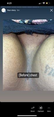 Before chest area treatment